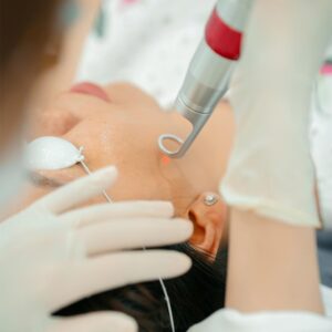 Điều trị nám bằng laser tại spa Long Thành