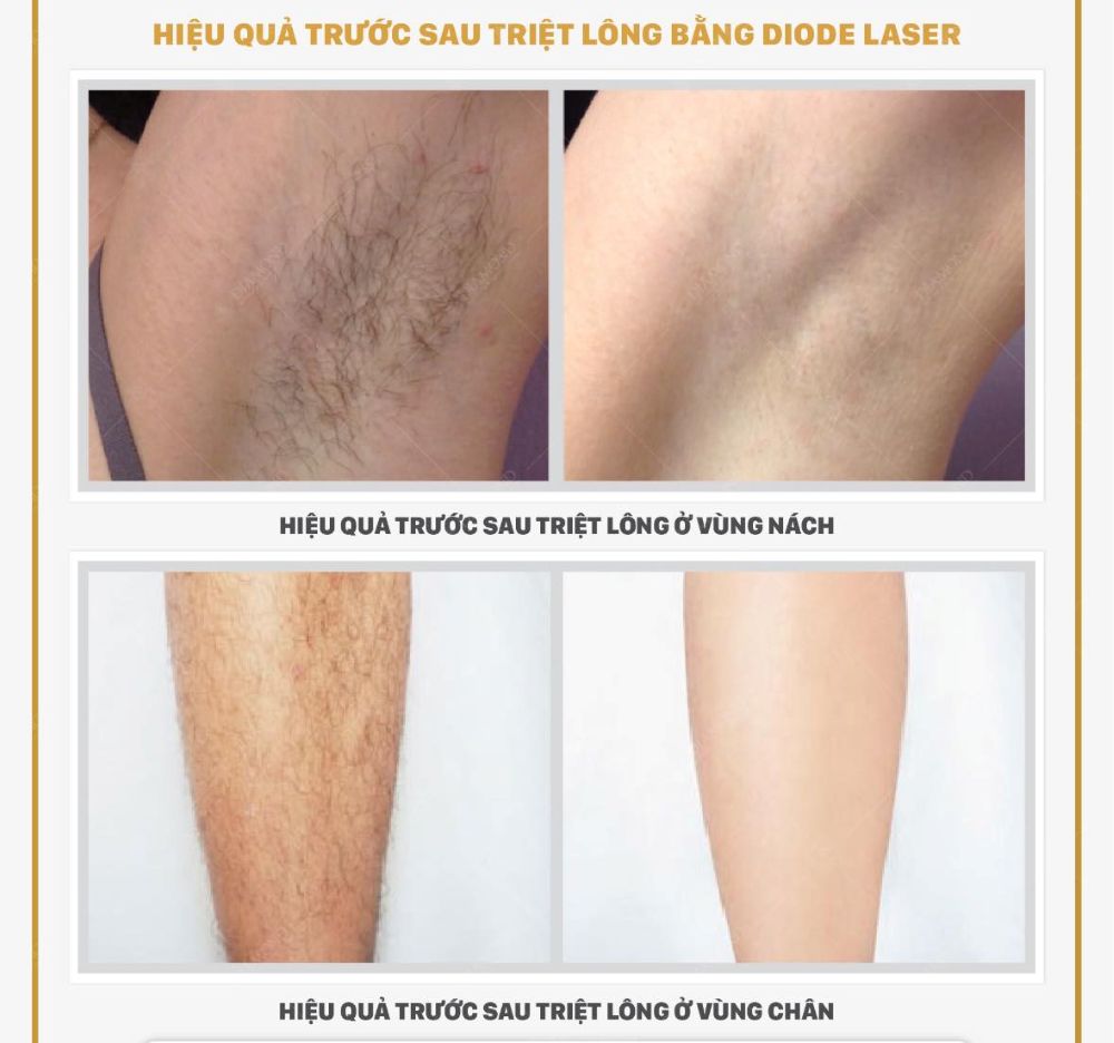 Hiệu quả spa triệt lông công nghệ mới nhất tại Long Thành